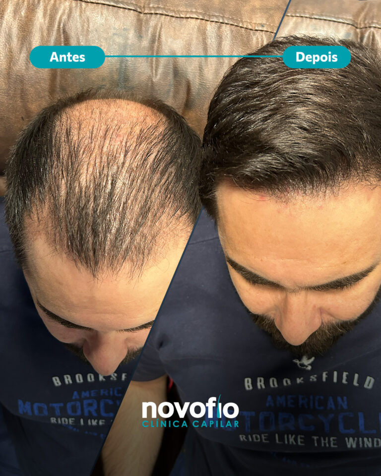 15._antes-e-depois-MAURO1
