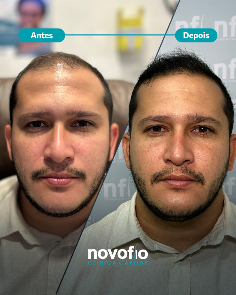 17._antes-e-depois-IGOR1