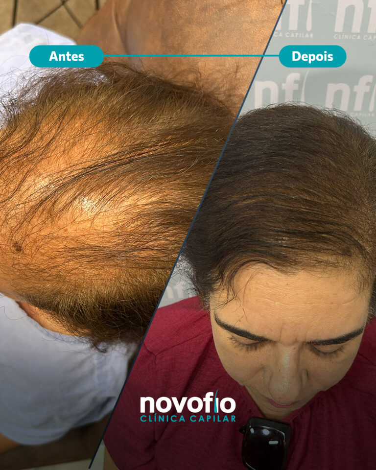 18._antes-e-depois-IRACEMA