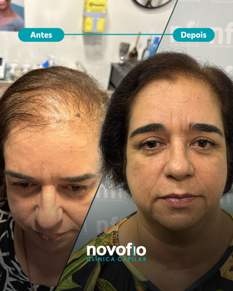 19._antes-e-depois-IRACEMA2