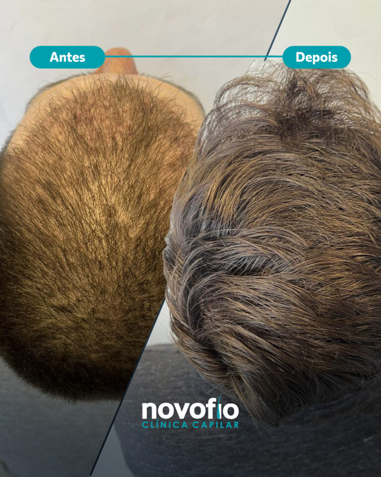 24._antes-e-depois-SEM-NOME2