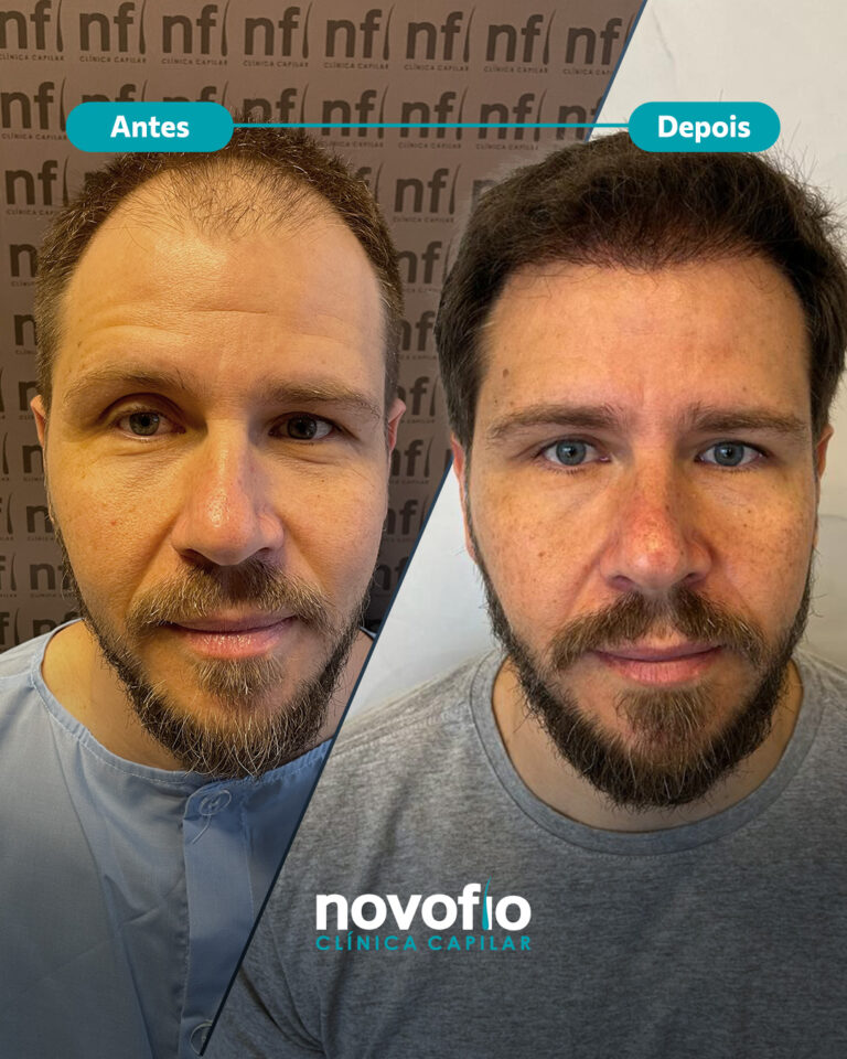 25._antes-e-depois-SEM-NOME3